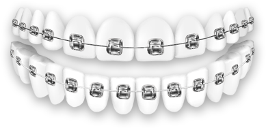 braces