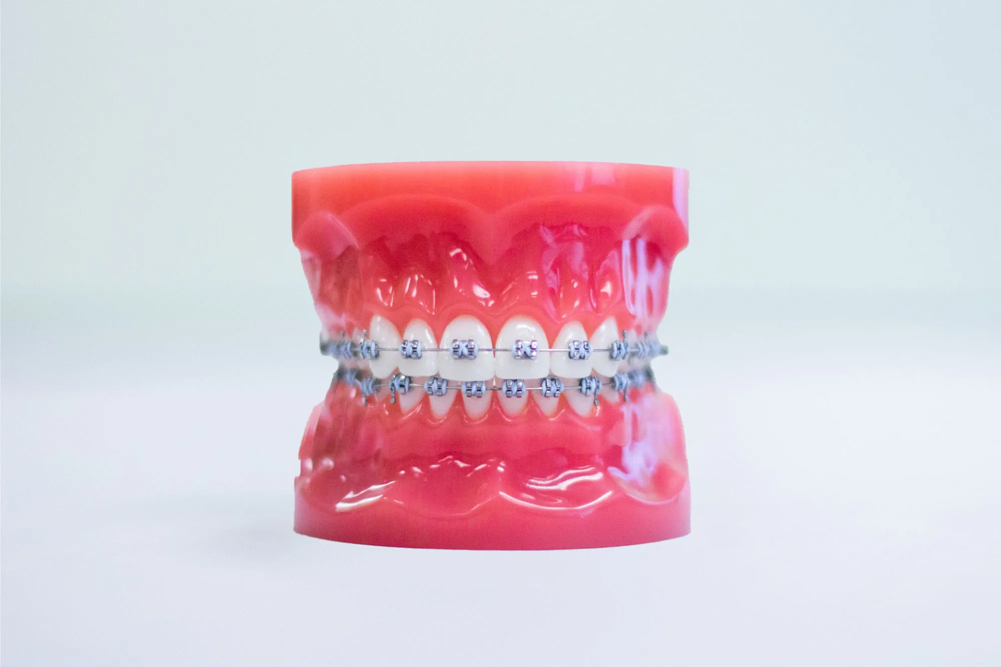 A typdont displays upper and lower teeth fitted with metal braces, including brackets and an archwire across both arches.